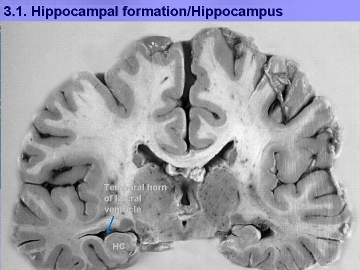 3. 1. Hippocampal formation/Hippocampus Temporal horn of lateral ventricle HC 