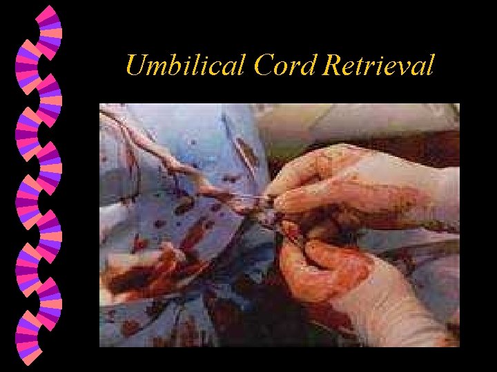 Umbilical Cord Retrieval 