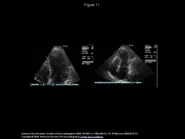 Figure 11 Journal of the American Society of Echocardiography 2005 181423. e 1 -1423.