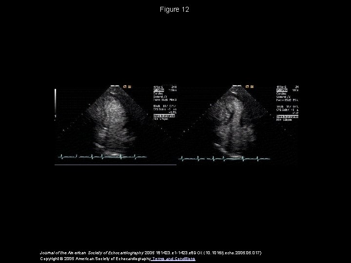 Figure 12 Journal of the American Society of Echocardiography 2005 181423. e 1 -1423.