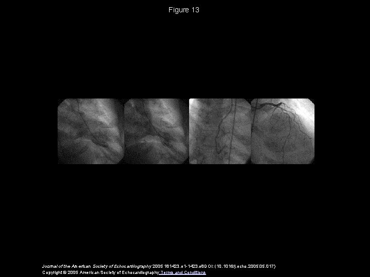 Figure 13 Journal of the American Society of Echocardiography 2005 181423. e 1 -1423.