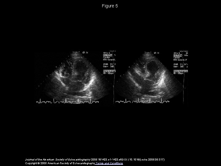 Figure 5 Journal of the American Society of Echocardiography 2005 181423. e 1 -1423.