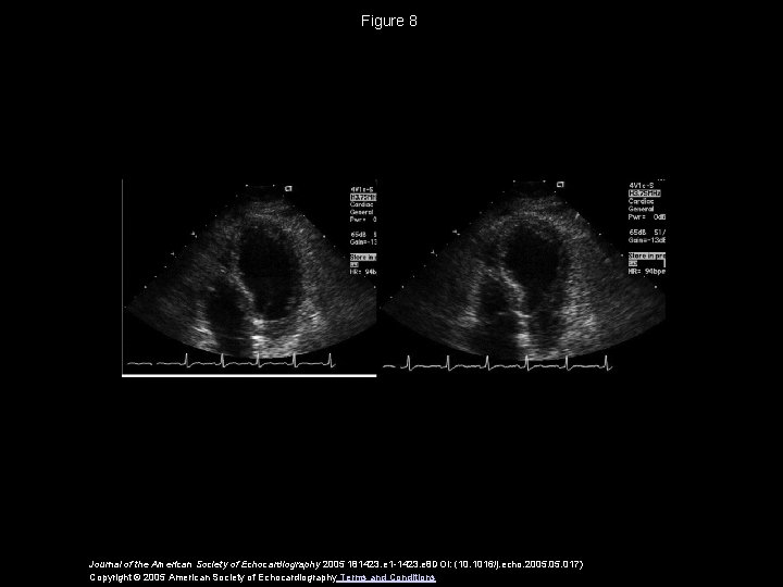 Figure 8 Journal of the American Society of Echocardiography 2005 181423. e 1 -1423.