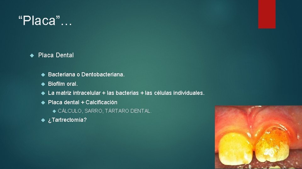“Placa”… Placa Dental Bacteriana o Dentobacteriana. Biofilm oral. La matriz intracelular + las bacterias