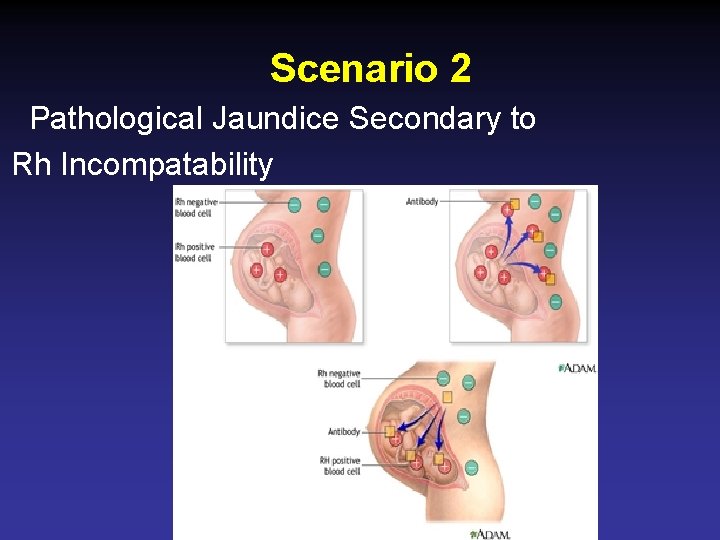 Scenario 2 Pathological Jaundice Secondary to Rh Incompatability 