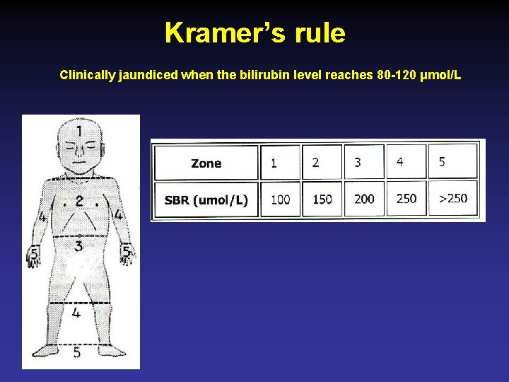 Kramer’s rule Clinically jaundiced when the bilirubin level reaches 80 -120 μmol/L 