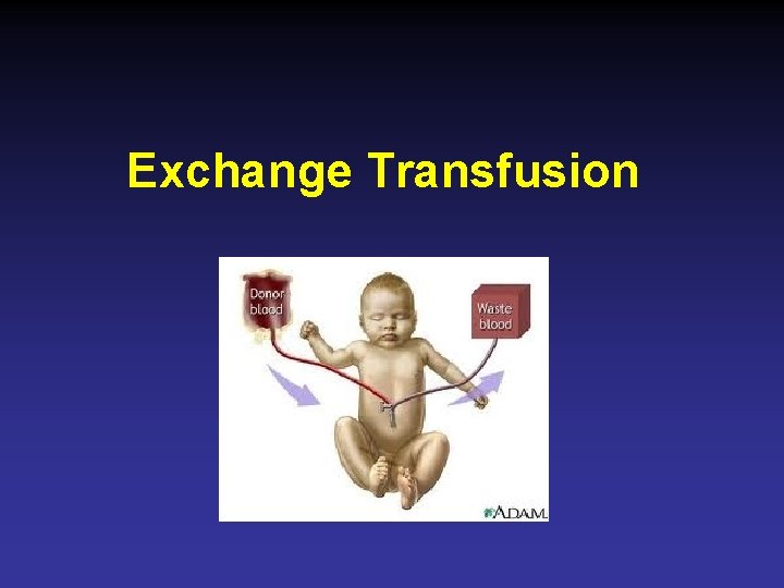 Exchange Transfusion 