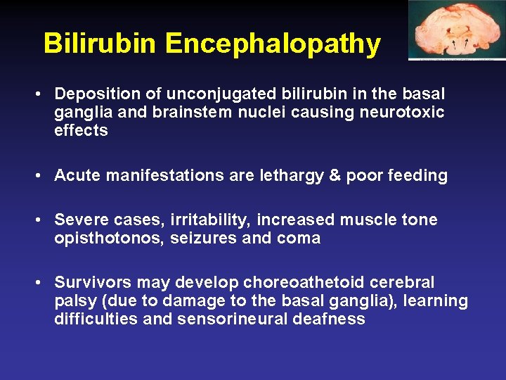 Bilirubin Encephalopathy • Deposition of unconjugated bilirubin in the basal ganglia and brainstem nuclei