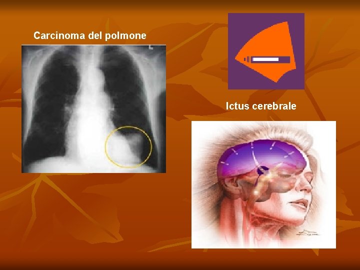 Carcinoma del polmone Ictus cerebrale 