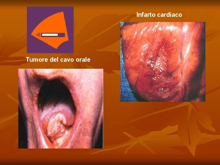 Infarto cardiaco Tumore del cavo orale 