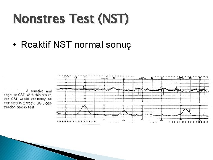 Nonstres Test (NST) • Reaktif NST normal sonuç 