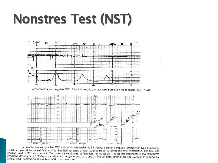 Nonstres Test (NST) 