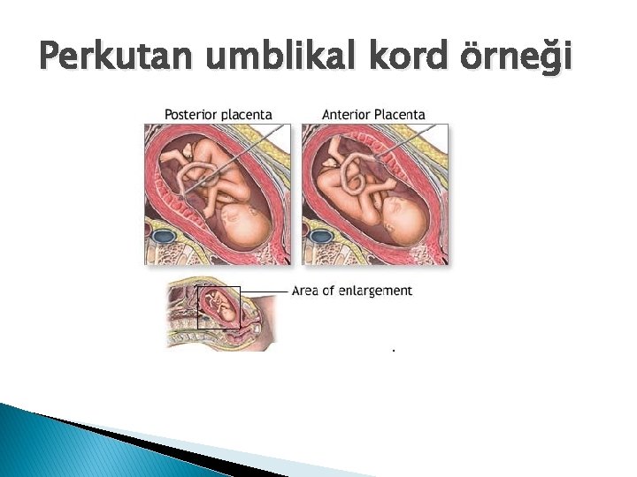 Perkutan umblikal kord örneği 