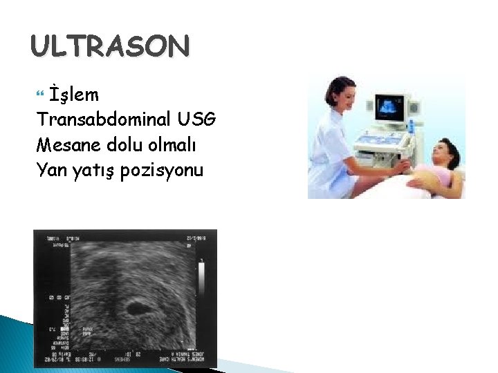 ULTRASON İşlem Transabdominal USG Mesane dolu olmalı Yan yatış pozisyonu 