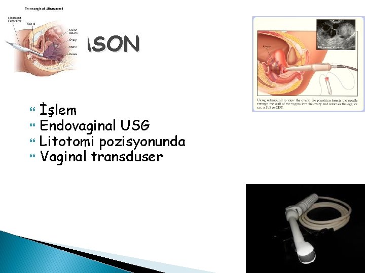 ULTRASON İşlem Endovaginal USG Litotomi pozisyonunda Vaginal transduser 