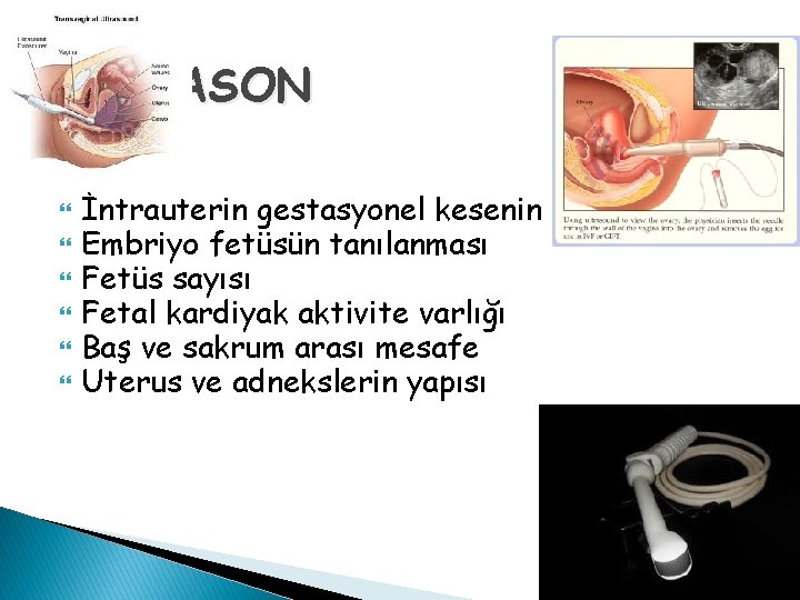 ULTRASON İntrauterin gestasyonel kesenin varlığı Embriyo fetüsün tanılanması Fetüs sayısı Fetal kardiyak aktivite varlığı
