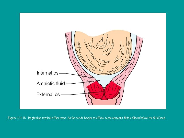 Figure 15– 11 b Beginning cervical effacement. As the cervix begins to efface, more