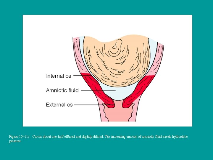 Figure 15– 11 c Cervix about one-half effaced and slightly dilated. The increasing amount