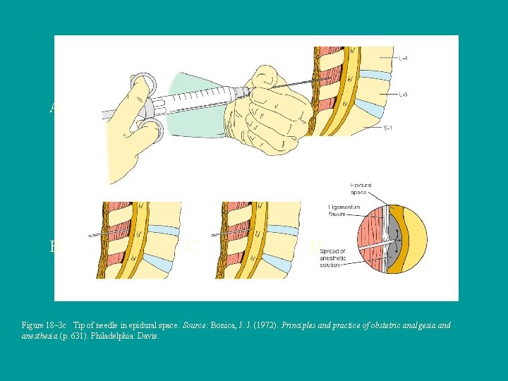 A B C D Figure 18– 3 c Tip of needle in epidural space.