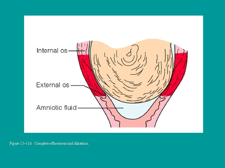 Figure 15– 11 d Complete effacement and dilatation. 