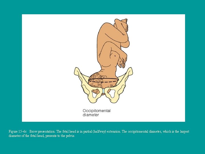 Figure 15– 6 c Brow presentation. The fetal head is in partial (halfway) extension.