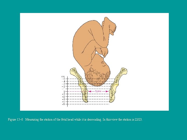 Figure 15– 8 Measuring the station of the fetal head while it is descending.