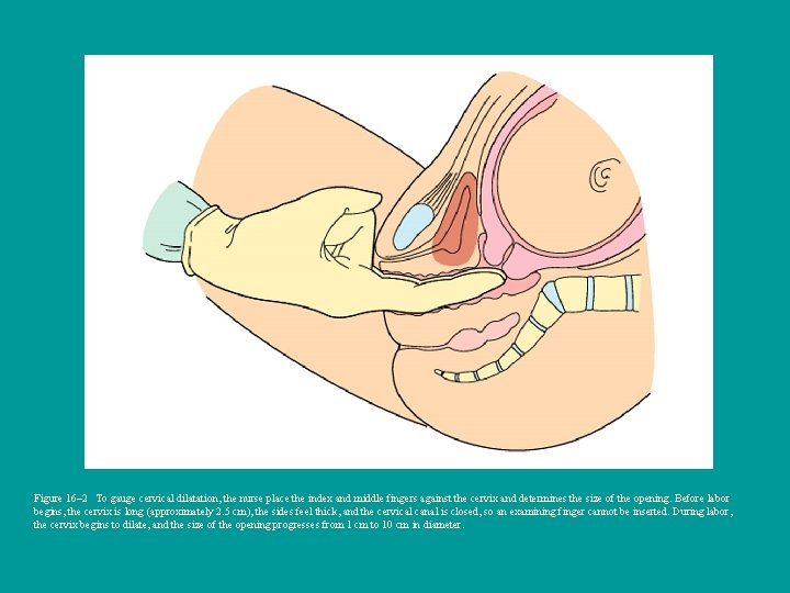 Figure 16– 2 To gauge cervical dilatation, the nurse place the index and middle