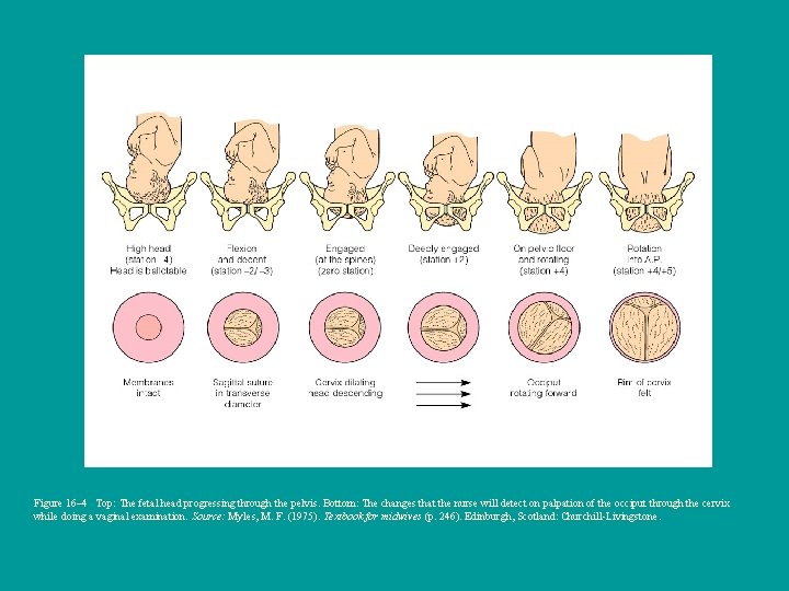 Figure 16– 4 Top: The fetal head progressing through the pelvis. Bottom: The changes