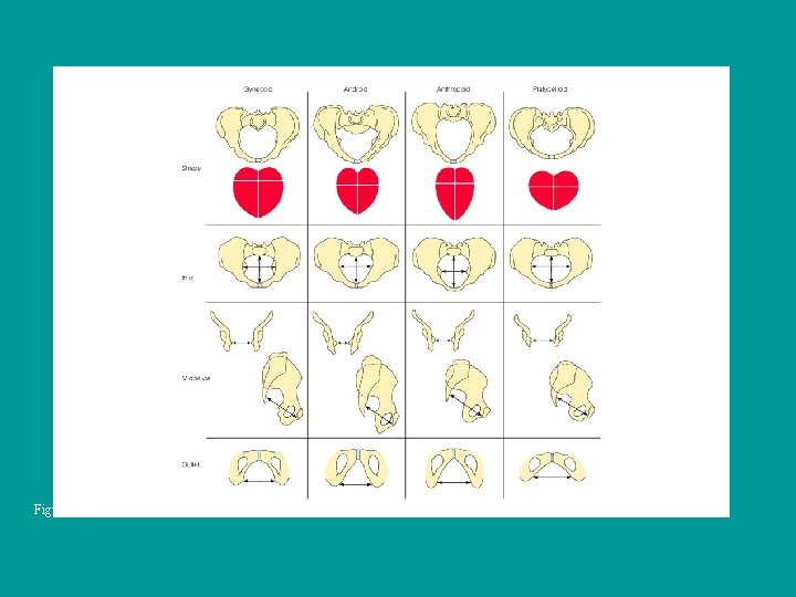 Figure 15– 1 Comparison of Caldwell-Moloy pelvic types. 