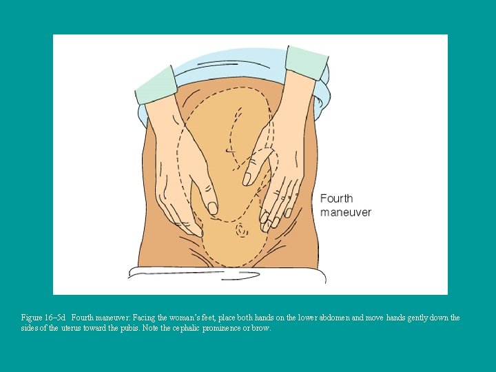 Figure 16– 5 d Fourth maneuver: Facing the woman’s feet, place both hands on