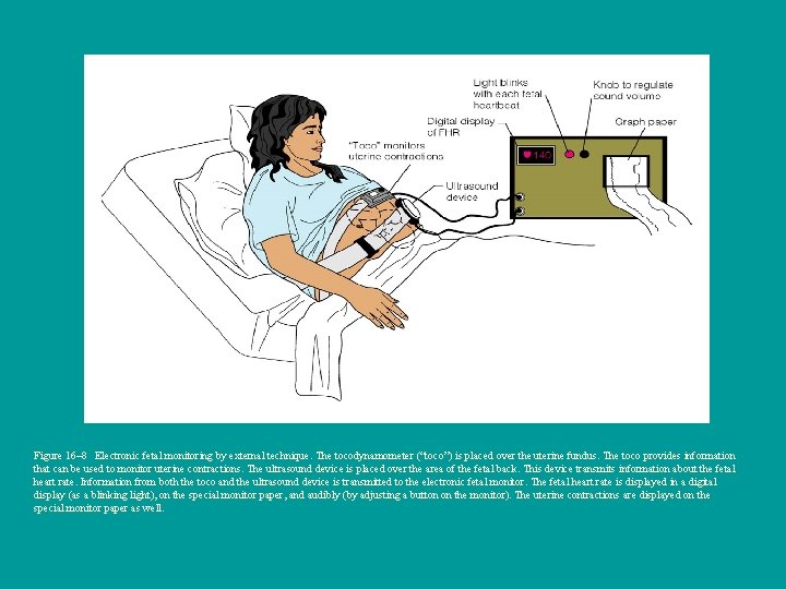 Figure 16– 8 Electronic fetal monitoring by external technique. The tocodynamometer (“toco”) is placed