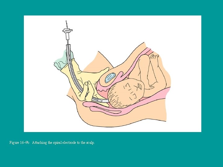 Figure 16– 9 b Attaching the spiral electrode to the scalp. 