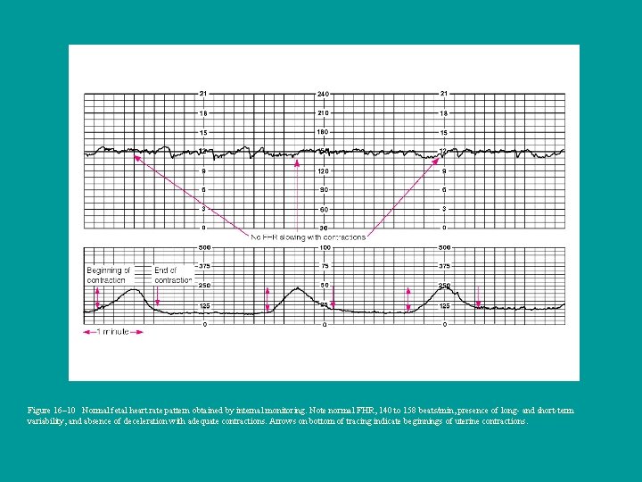 Figure 16– 10 Normal fetal heart rate pattern obtained by internal monitoring. Note normal