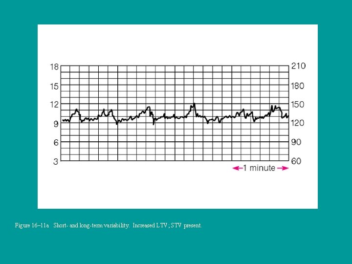 Figure 16– 11 a Short- and long-term variability. Increased LTV; STV present. 