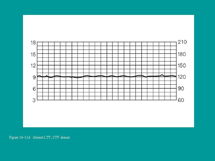 Figure 16– 11 d Absent LTV; STV absent. 