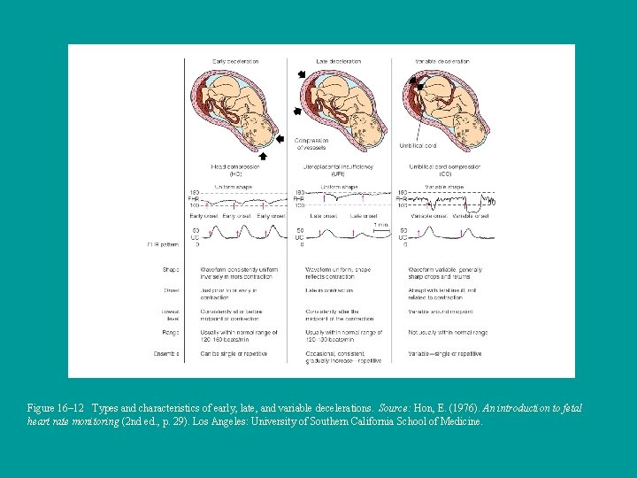 Figure 16– 12 Types and characteristics of early, late, and variable decelerations. Source: Hon,