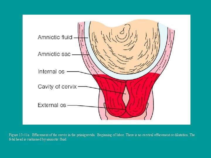 Figure 15– 11 a Effacement of the cervix in the primigravida. Beginning of labor.