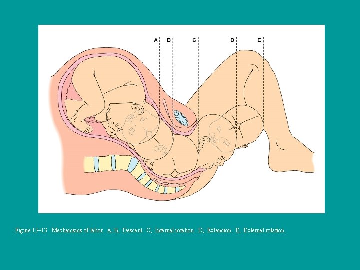 Figure 15– 13 Mechanisms of labor. A, B, Descent. C, Internal rotation. D, Extension.