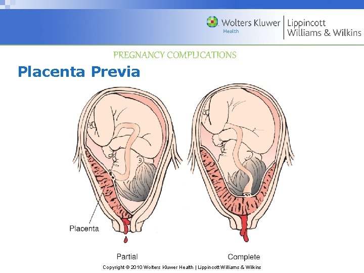 PREGNANCY COMPLICATIONS Placenta Previa Copyright © 2010 Wolters Kluwer Health | Lippincott Williams &