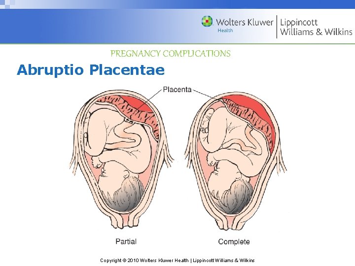 PREGNANCY COMPLICATIONS Abruptio Placentae Copyright © 2010 Wolters Kluwer Health | Lippincott Williams &