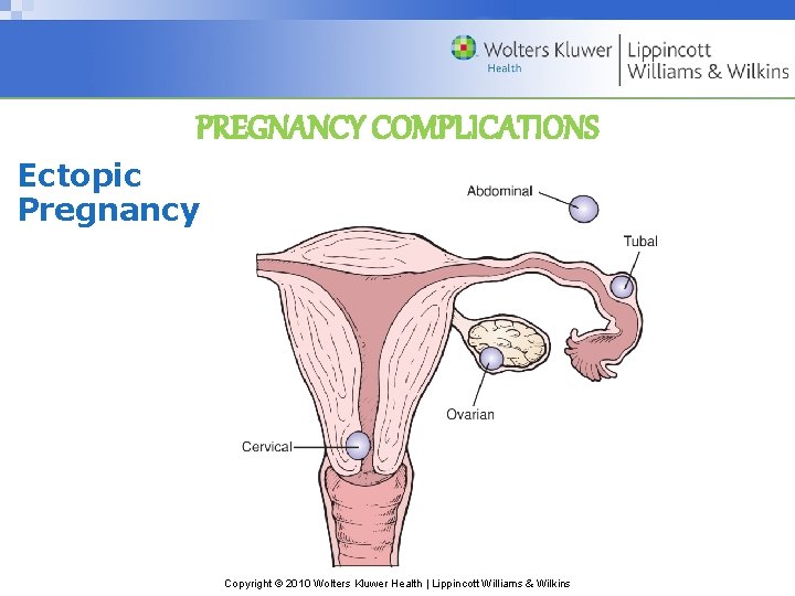 PREGNANCY COMPLICATIONS Ectopic Pregnancy Copyright © 2010 Wolters Kluwer Health | Lippincott Williams &