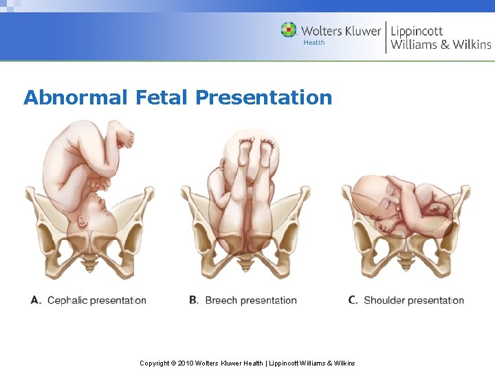 Abnormal Fetal Presentation Copyright © 2010 Wolters Kluwer Health | Lippincott Williams & Wilkins