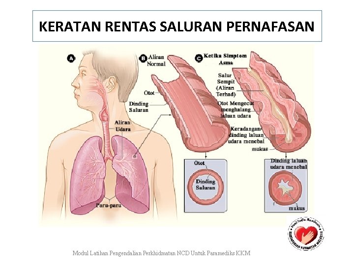 KERATAN RENTAS SALURAN PERNAFASAN Modul Latihan Pengendalian Perkhidmatan NCD Untuk Paramediks KKM 