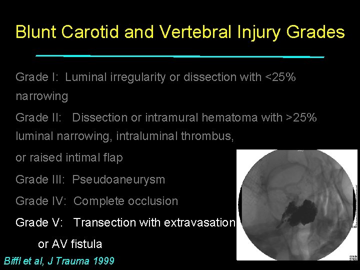 Blunt Carotid and Vertebral Injury Grades Grade I: Luminal irregularity or dissection with <25%
