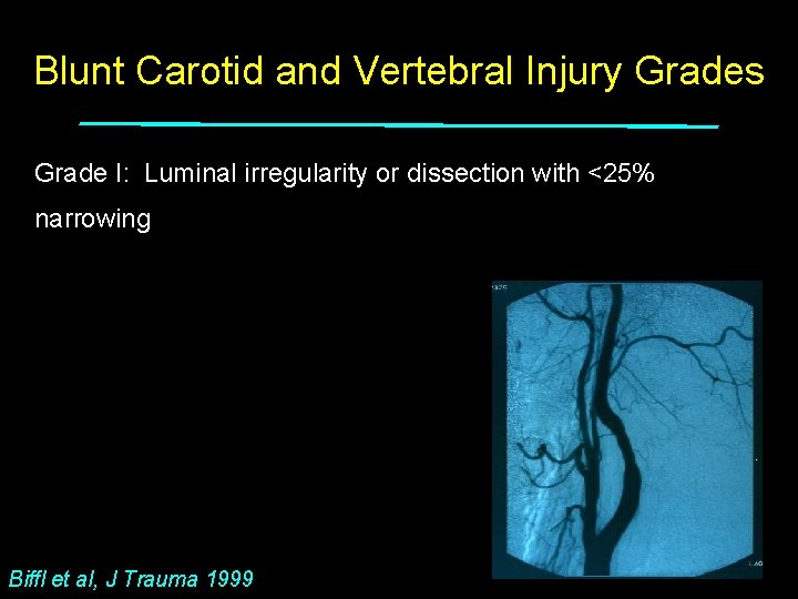 Blunt Carotid and Vertebral Injury Grades Grade I: Luminal irregularity or dissection with <25%