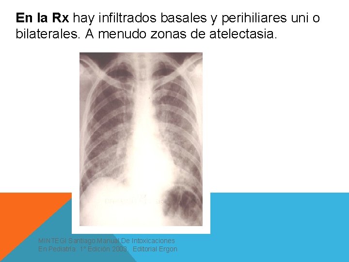 En la Rx hay infiltrados basales y perihiliares uni o bilaterales. A menudo zonas