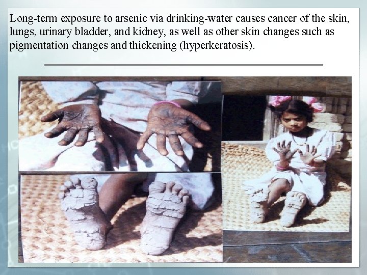 Long-term exposure to arsenic via drinking-water causes cancer of the skin, lungs, urinary bladder,