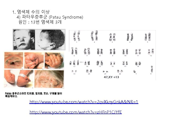 1. 염색체 수의 이상 4) 파타우증후군 (Patau Syndrome) 원인 : 13번 염색체 3개 http: