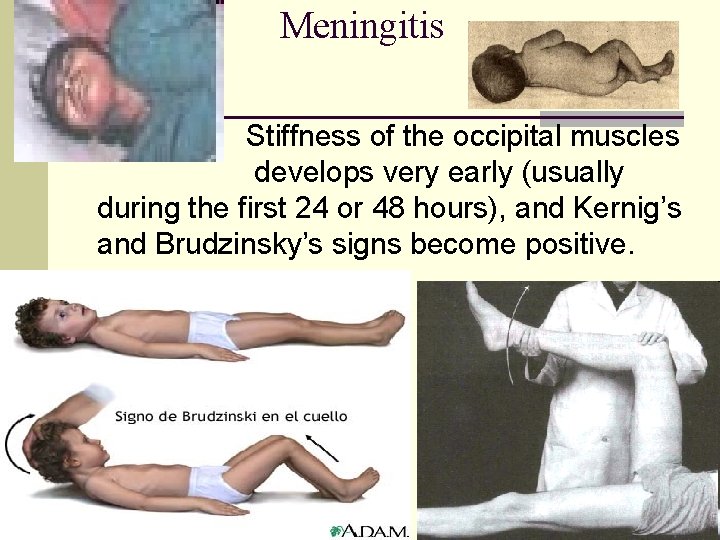 Meningitis Stiffness of the occipital muscles develops very early (usually during the first 24