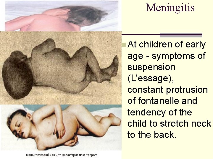 Meningitis n At children of early age - symptoms of suspension (L'essage), constant protrusion